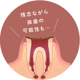 残念ながら抜歯の可能性も