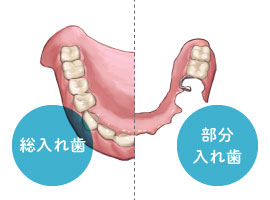 レジン床入れ歯