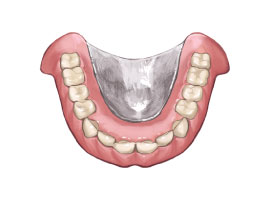 金属床入れ歯