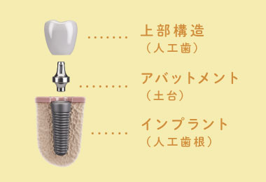 上部構造（人工歯）、アバットメント（土台）、インプラント（人工歯根）