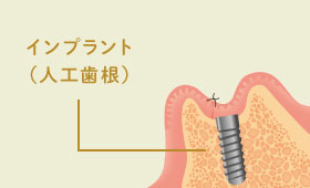 インプラント（人工歯根）