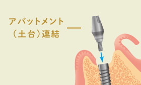 アバットメント（土台）連結