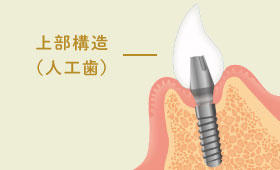 上部構造（人工歯）