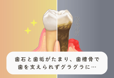 歯石と歯垢が溜まり、歯槽骨で歯を支えられずグラグラに…