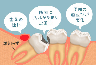 歯茎の腫れ・隙間に汚れが溜まり虫歯に・周囲の歯並びが悪化